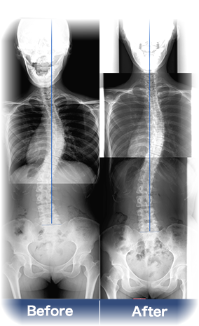 飯田橋の整体】側彎症・腰痛なら光カイロプラクティック